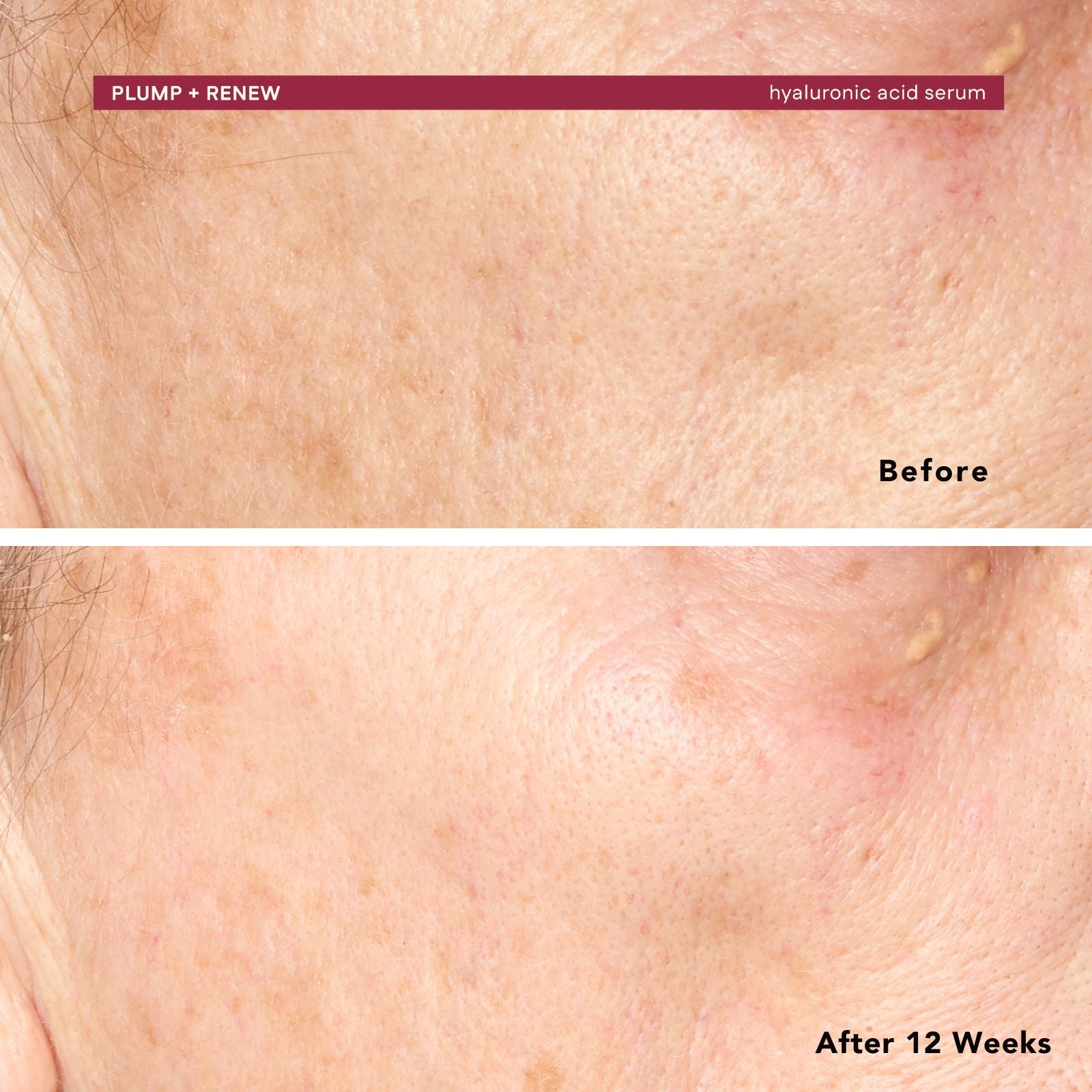 Before and after comparison of skin treatment with 'Plump + Renew' hyaluronic acid serum.