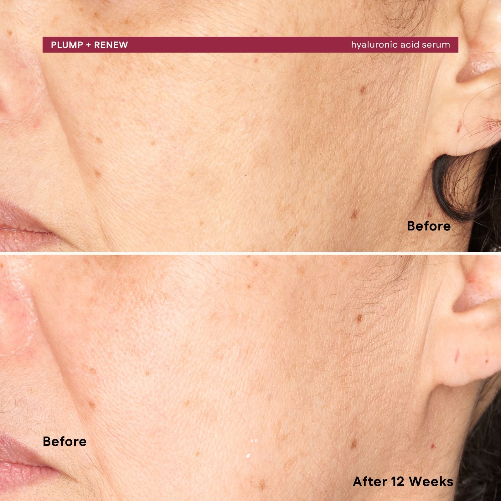 Before and after comparison of skin treatment with 'Plump + Renew' hyaluronic acid serum.