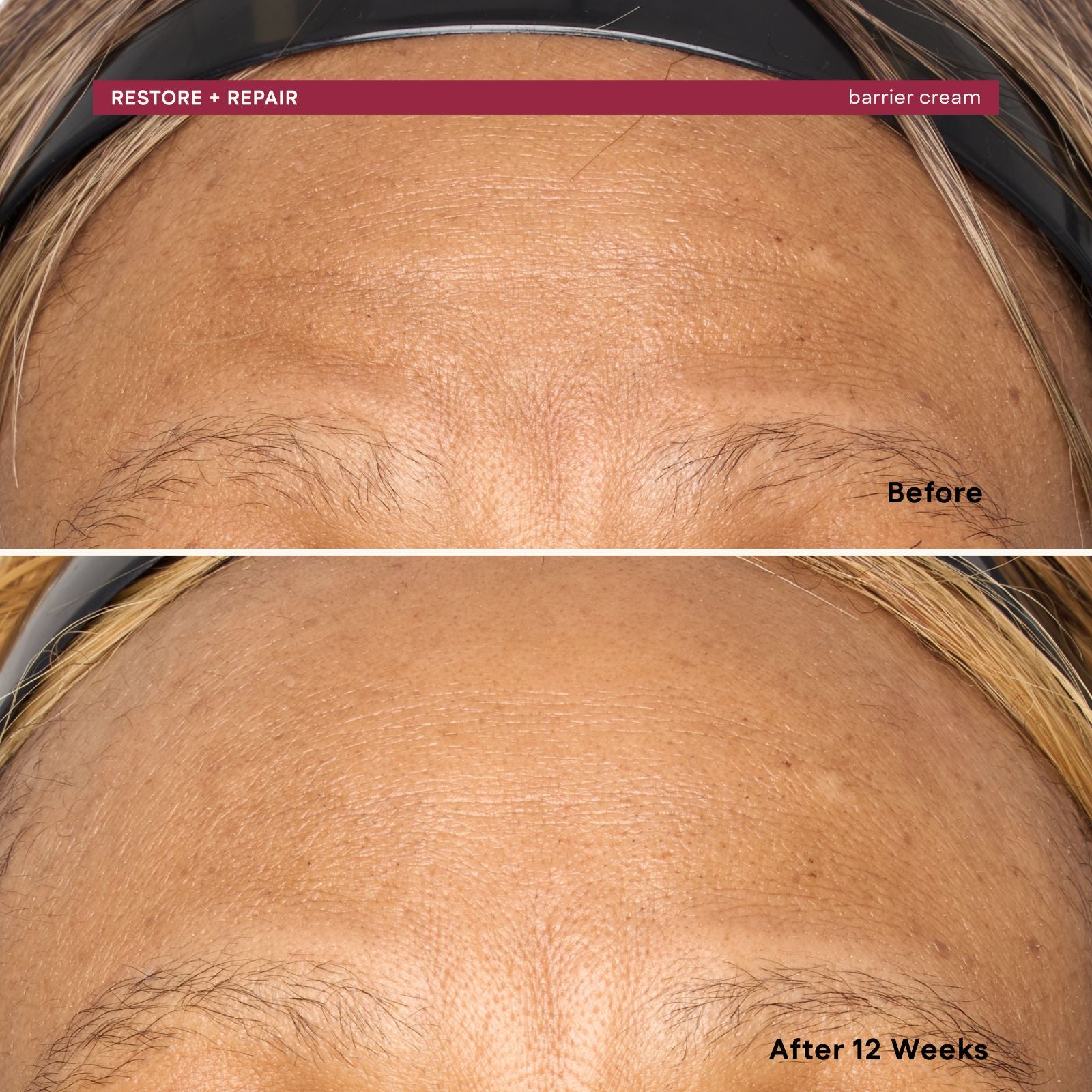 Before and after comparison of a person's forehead with a barrier cream application, showing visible improvement over 12 weeks.