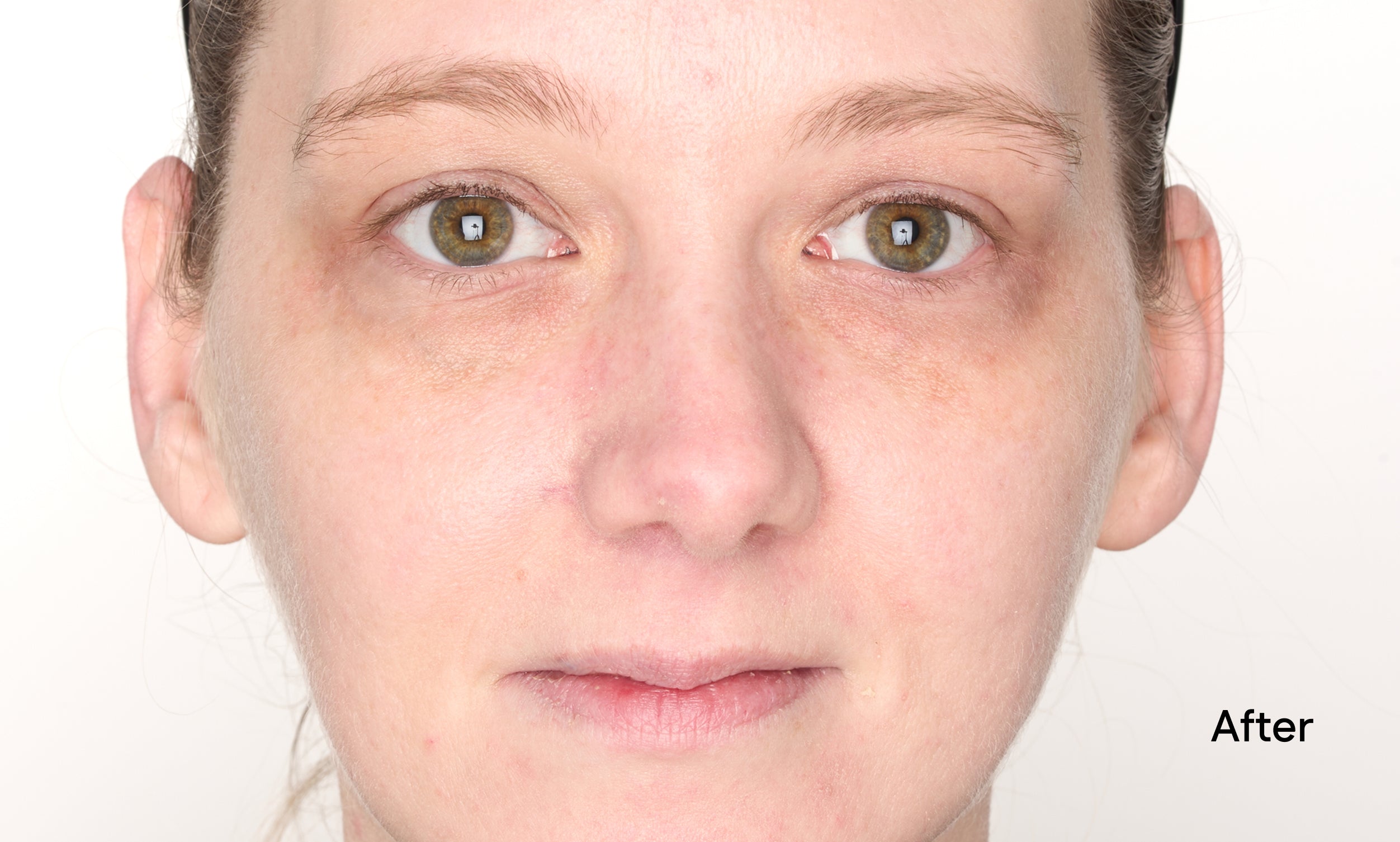 Close-up of a person's face with 'After' text on a white background