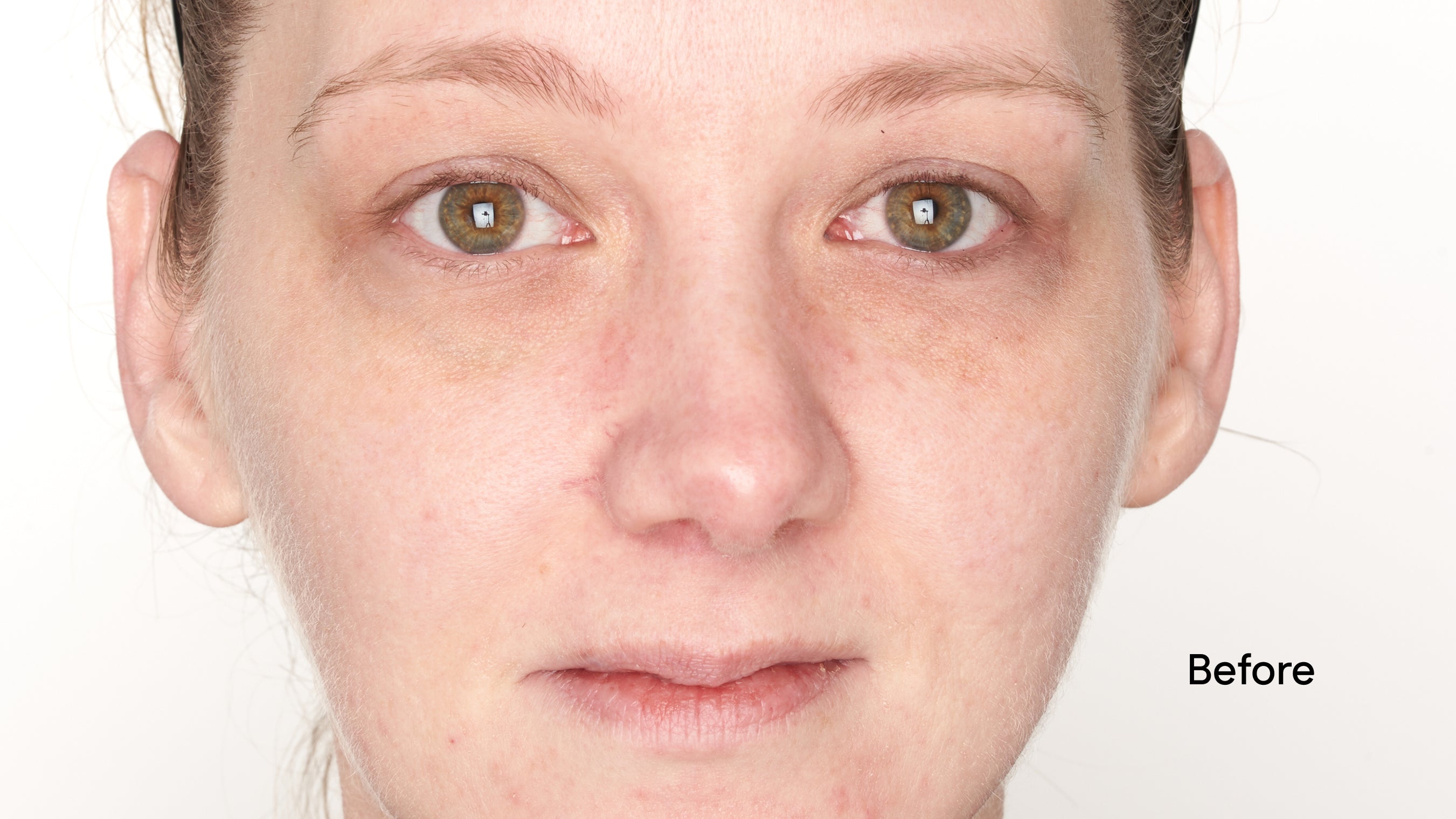 Close-up of a person's face with 'Before' label on a white background